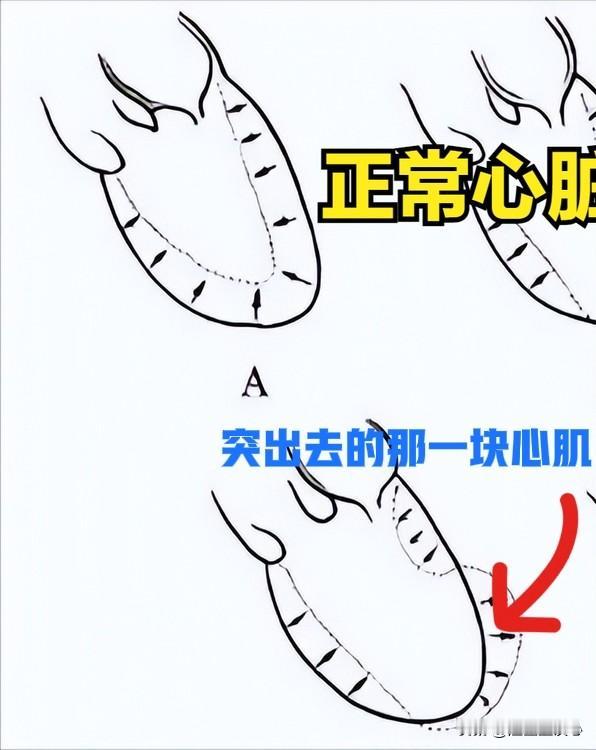 心脏室壁瘤是心脏长肿瘤吗?前几天门诊时候碰到一个68岁女性患者,因为胸痛一次到医