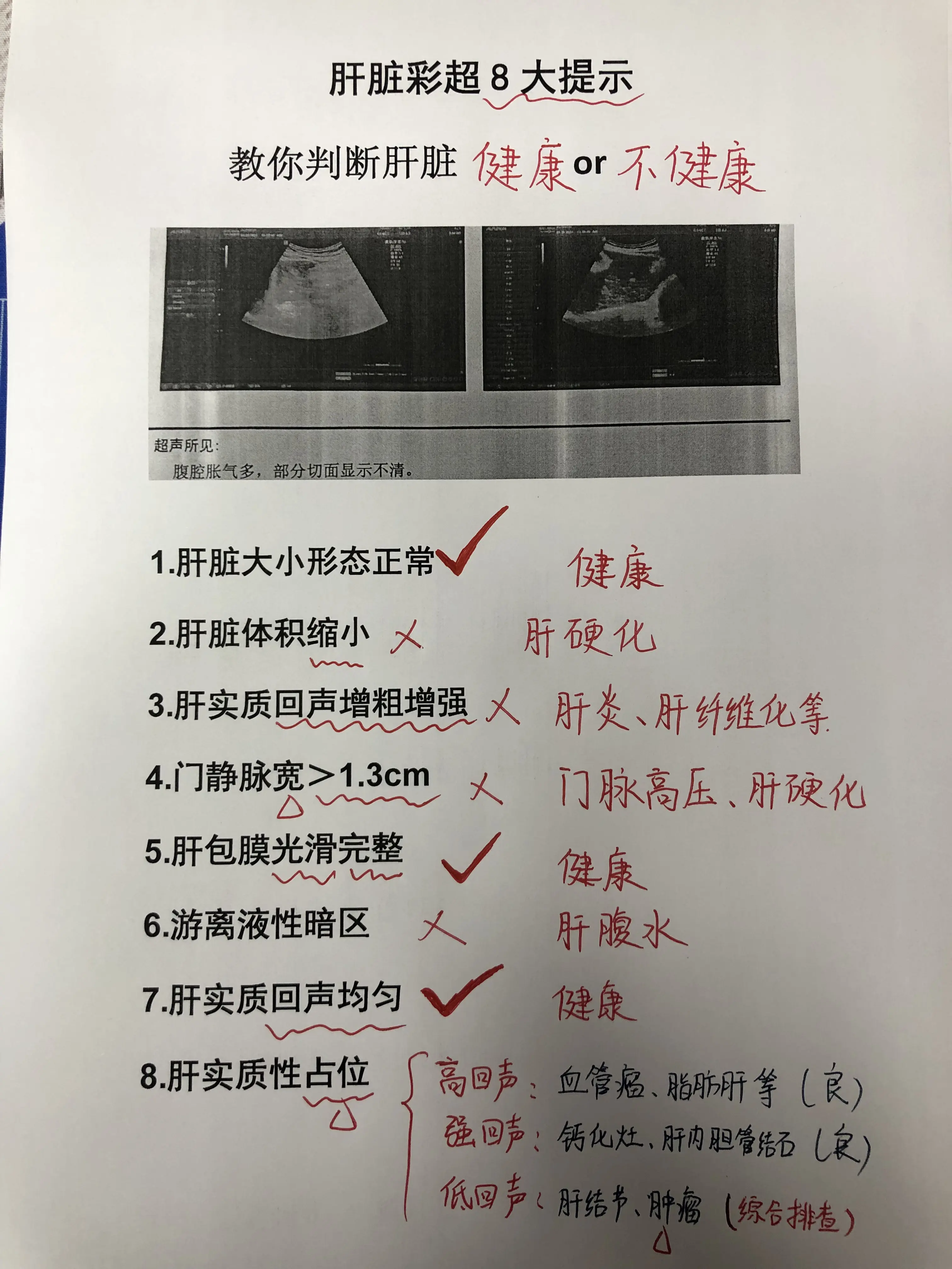 乙肝 肝硬化 肝脏彩超 肝炎 肝病教授陈士俊