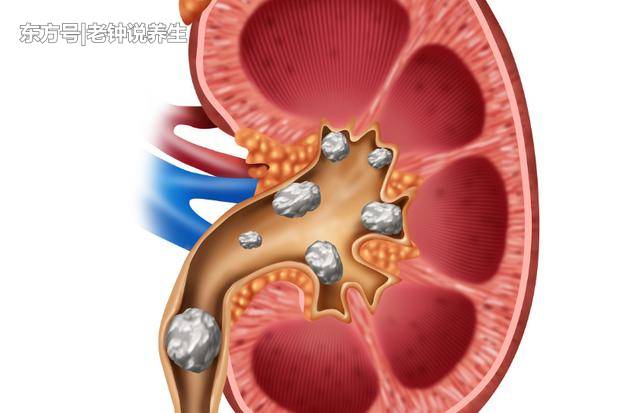 "碎石"是肾结石的必走之路吗 中医一味药可"溶石"