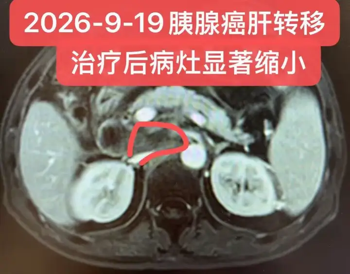 个案交流：晚期胰腺癌肝转移的治疗。该患者，49岁，男性。病理：肝穿刺示...