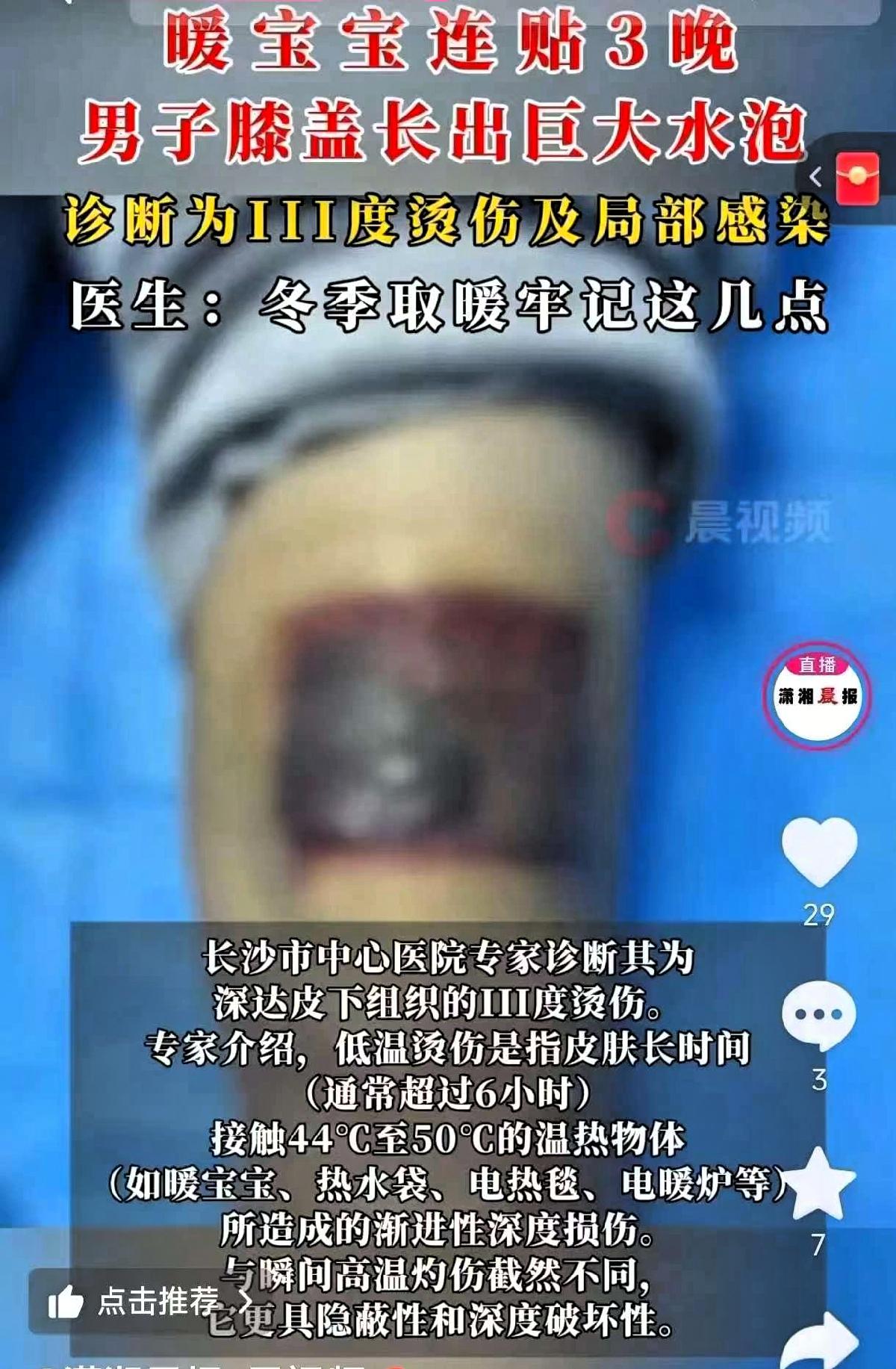 “悲剧还是发生了！”湖南长沙的张先生，因为老寒腿膝盖隐隐作痛，就想着用暖宝宝缓解