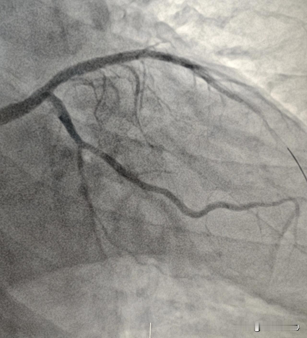 第一，把低密度脂蛋白胆固醇降低到1.4以下。很多人关注化验单上面的参考范围，实际