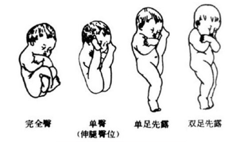 臀位:如果胎儿头和臀颠倒过来,臀在下头在上,是臀先露,这种胎位叫
