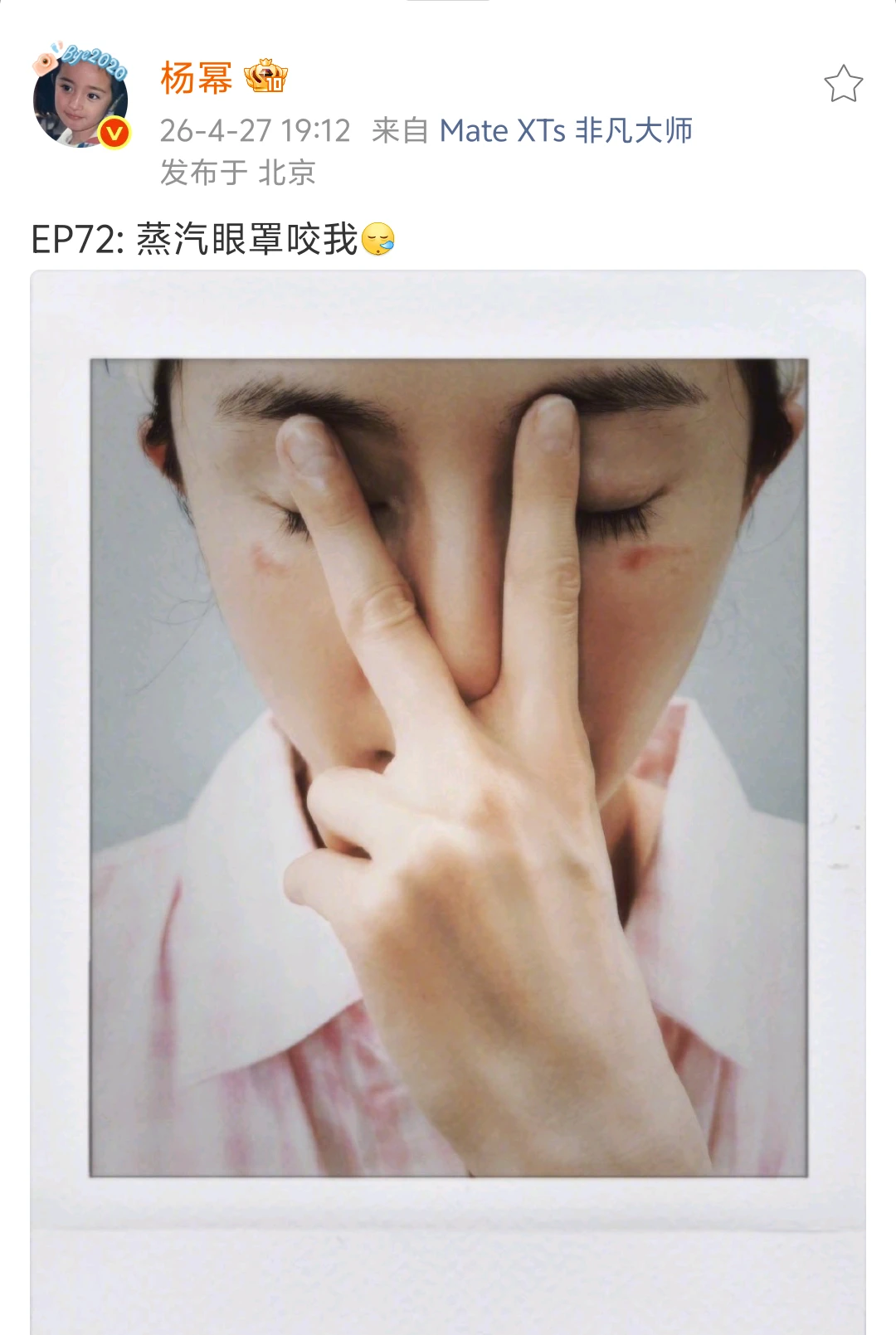 幂姐脸被蒸汽眼罩烫伤了