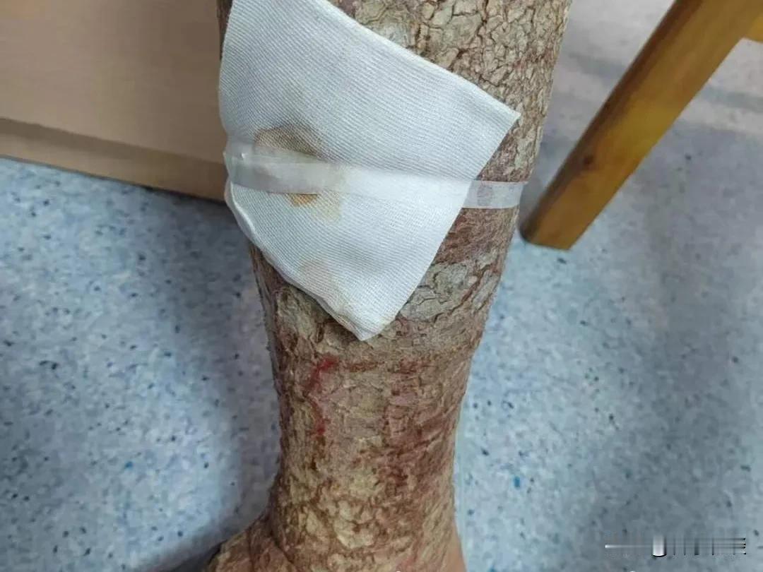 好家伙！腿痒挠挠就没事了？有一位大哥把自己的腿挠成“树皮腿”!有一大哥觉得腿