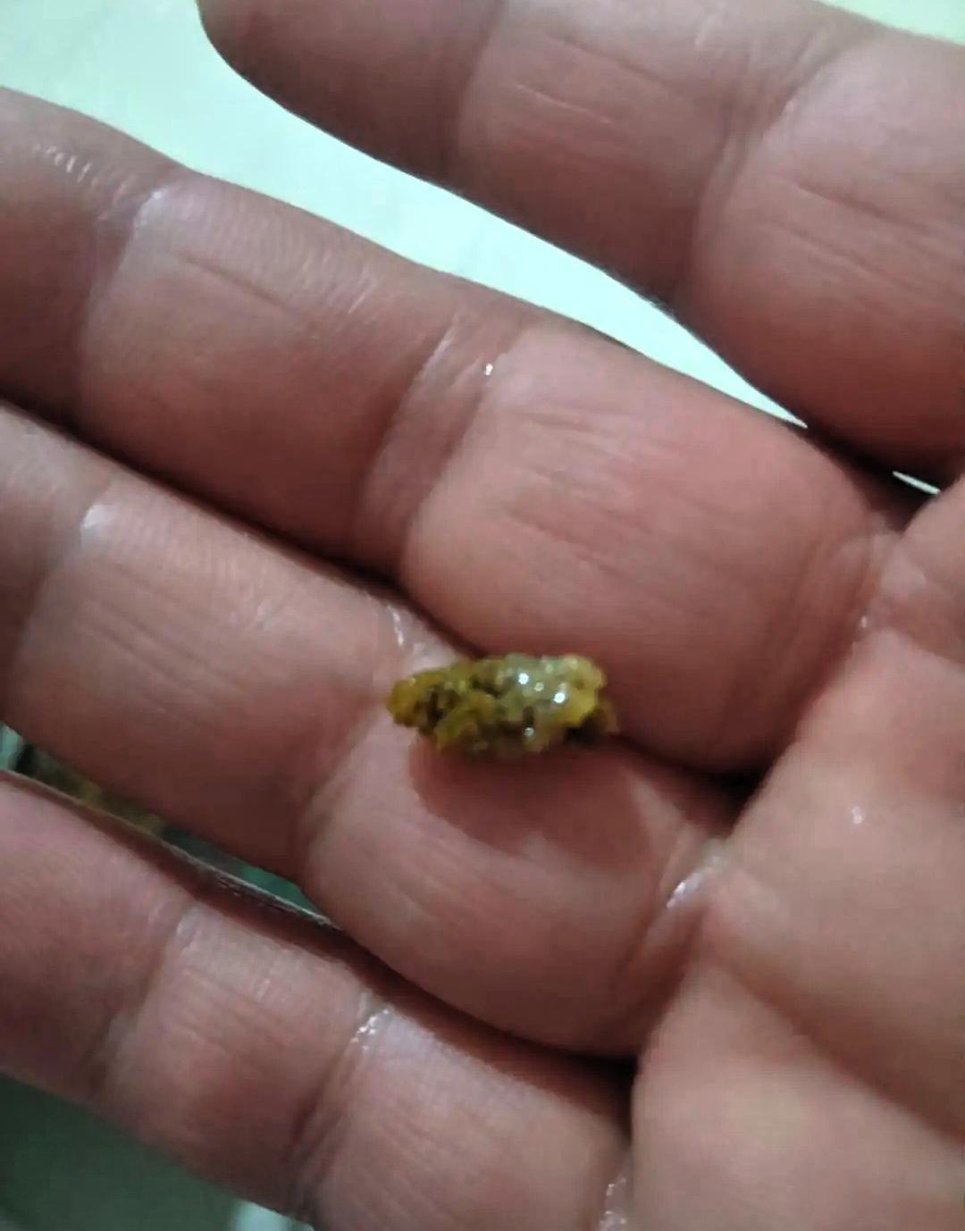 结石排出来就没事了？我告诉你，最危险的时候才刚刚开始。我是下午两点多见的医生