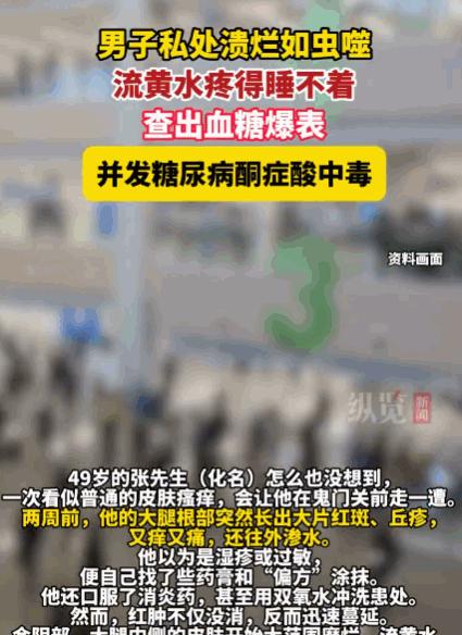 太大意了！深圳，一49岁的男子大腿根突发红斑丘疹，又痒又痛。他误以为是湿疹，自行