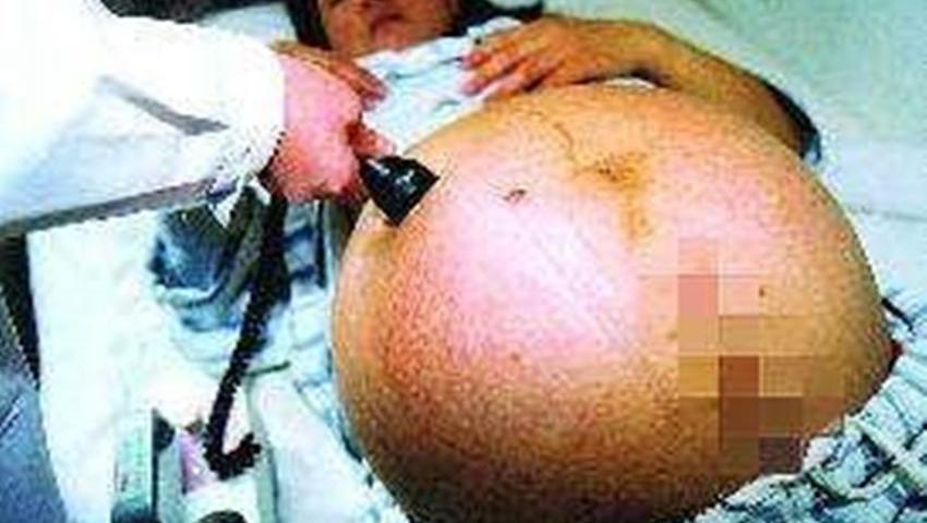 宜进人口刨腹产好吗(3)