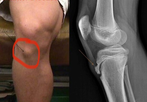 什么是胫骨结节骨骺炎前两天有家长提问，自己孩子膝盖下方鼓出来一块骨头，还会疼