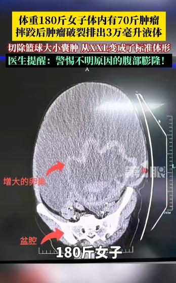 “离大谱！”浙江一女子常年减肥，180斤的体重愣是没变化。意外摔了一跤后，大肚子