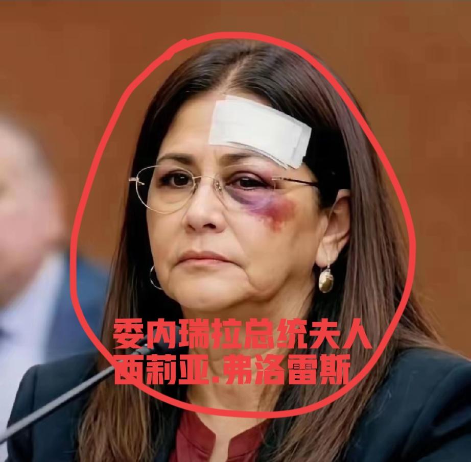 最看不惯打女人，但是，这位总统夫人就被美军打成这样，委内瑞拉总统夫人西莉亚.弗洛