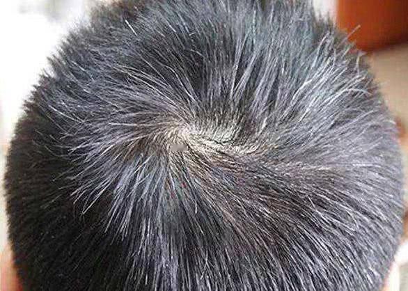 血热了，长白发，头发干枯，六味中药，滋阴补精血，让头发营养充足 现在大家能发