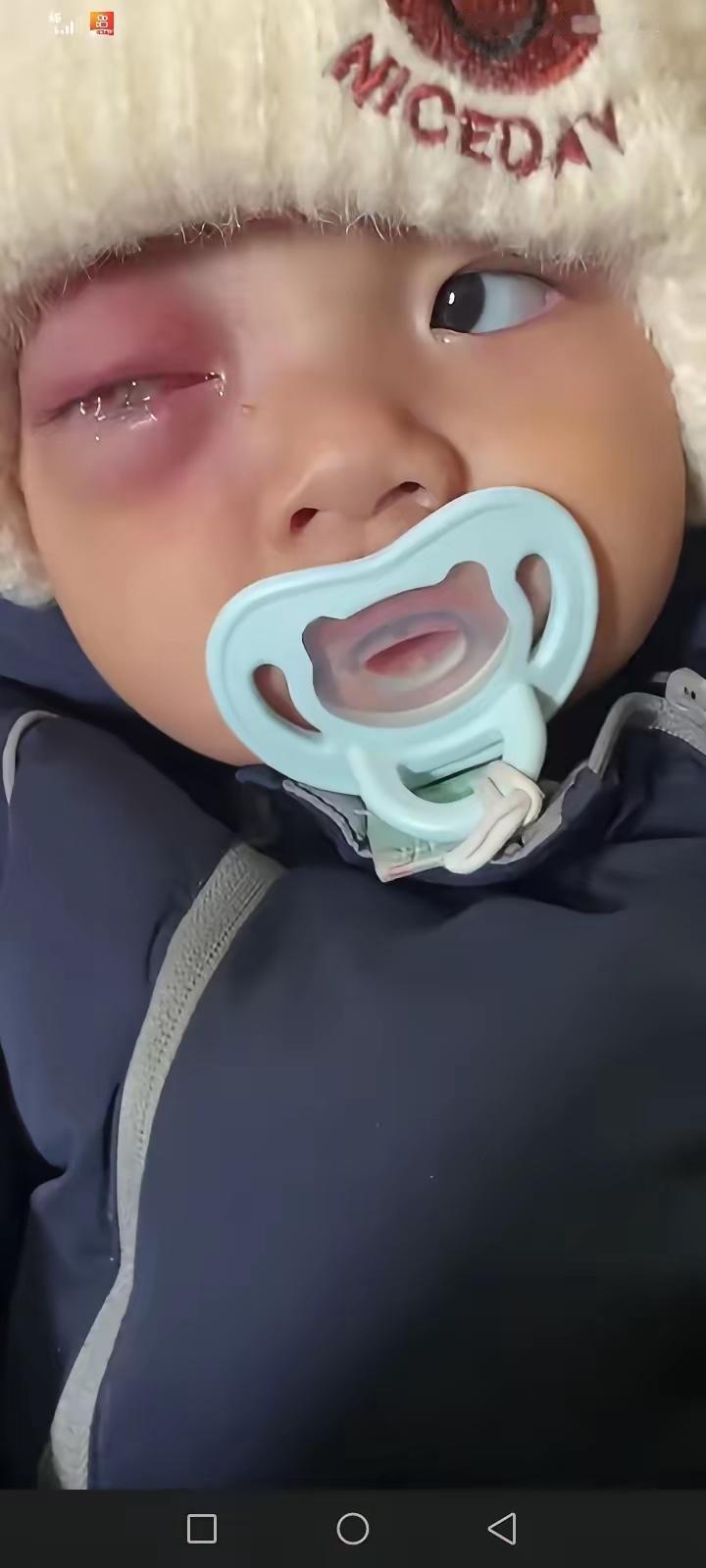 天塌了，宝宝一次摔倒，磕碰到眼了，爸妈都没在意，儿子眼越来越严重，已经导致失明，