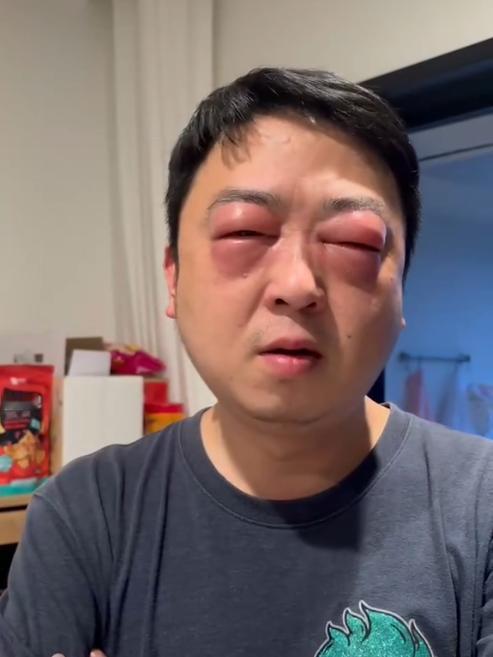 “吃小龙虾怎么会把眼睛吃成这样？”江苏一男子买了几斤小龙虾，洗干净后做了盘色香味