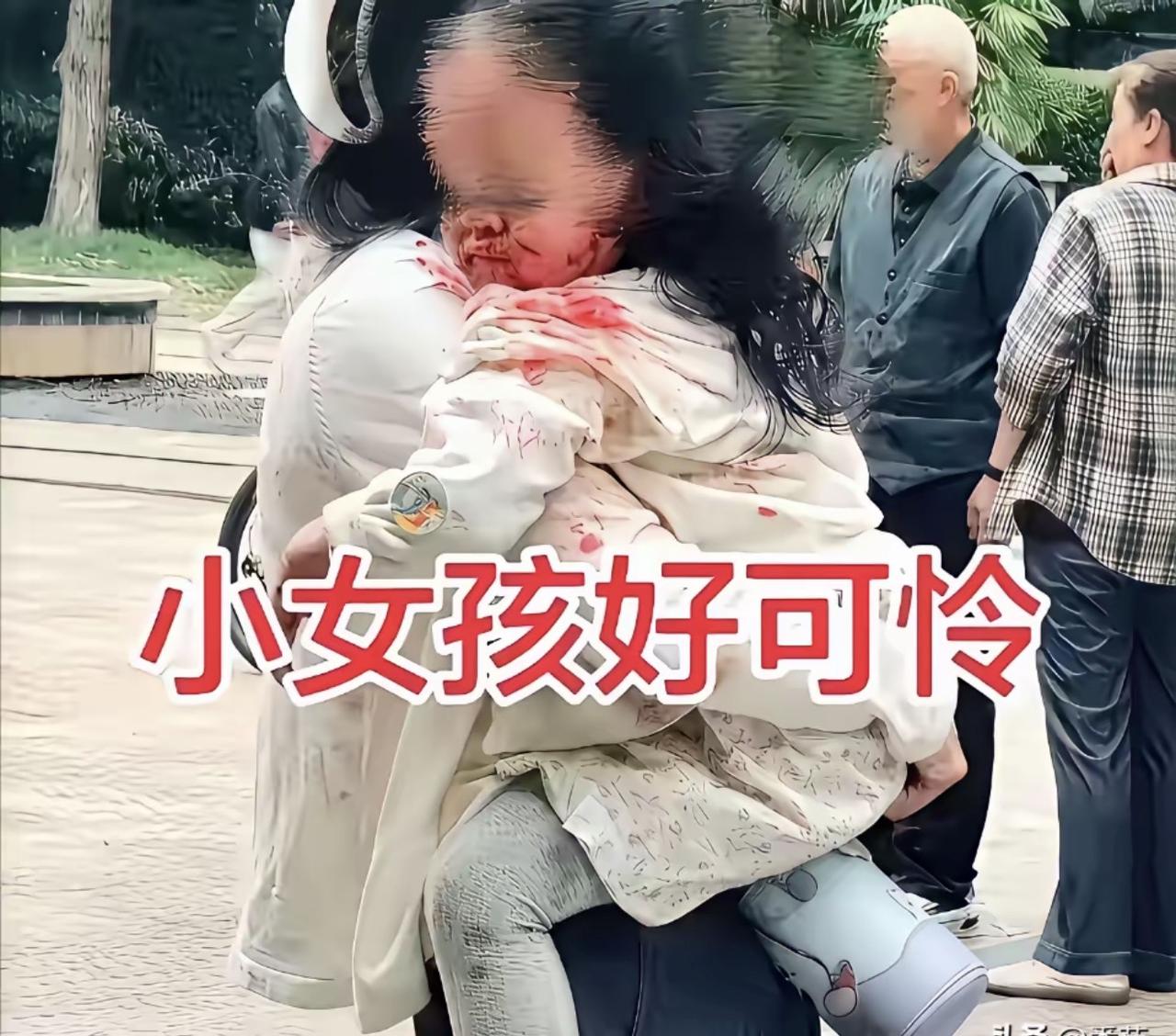 狗绳攥在手里，人却没拽。3岁女童被咬到近乎毁容，我最恨的不是那条狗，是那个