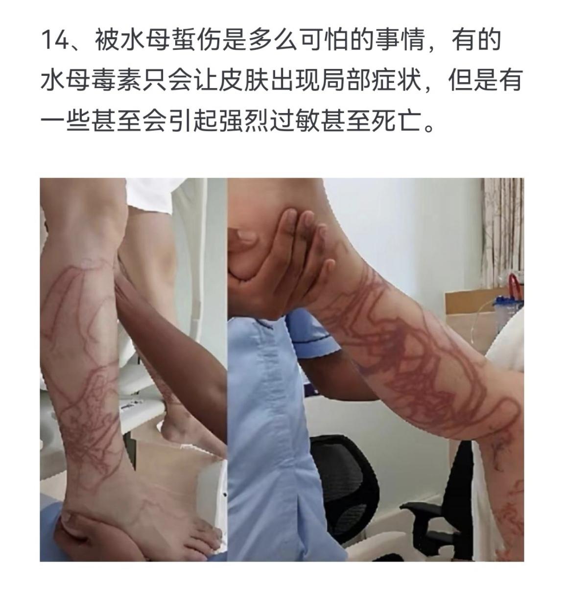 被水母蜇伤是多么可怕的事情