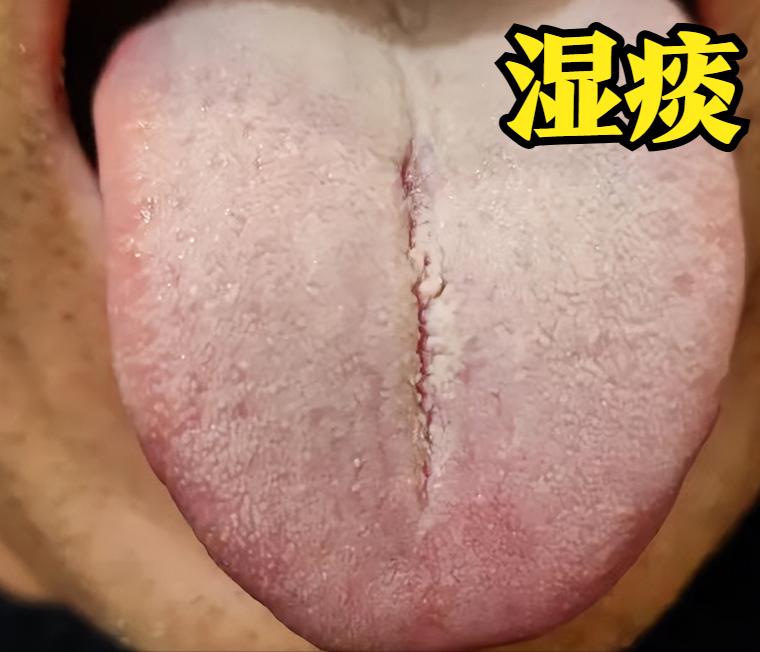 大家好，我是中医陈大夫！不少朋友总被一种“难缠的痰”困扰——咳出来的痰是