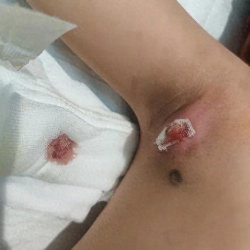 5岁男孩腋下包块一个月疯长，疼到手臂不敢放下！多家医院无解，直到妈妈随口说了一句
