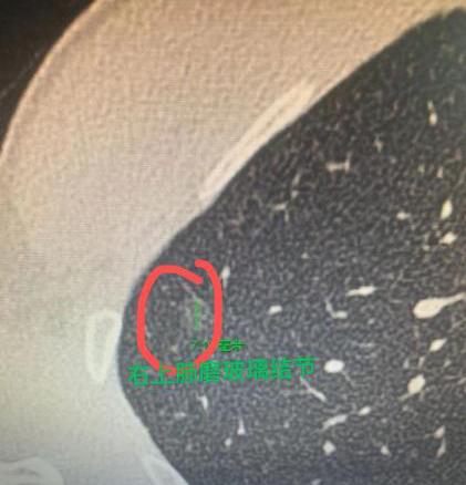 肺结节不一定非要手术，这些情况可能会自行消失！跟你们说个真实案例，其实很多肺结节