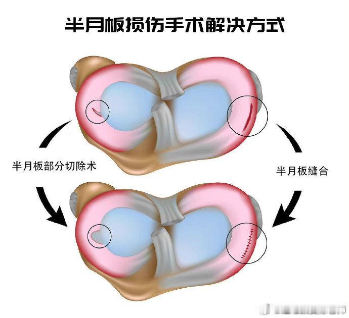 膝盖疼痛【损伤康复说明书——半月板损伤】半月板是我们膝盖里的“减震器”，很多