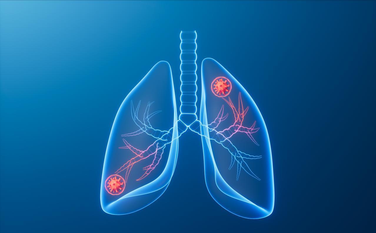 肺癌结节只有8mm就转移到了胸膜失去了根治机会，虽然很少见，但的确存在结节长在