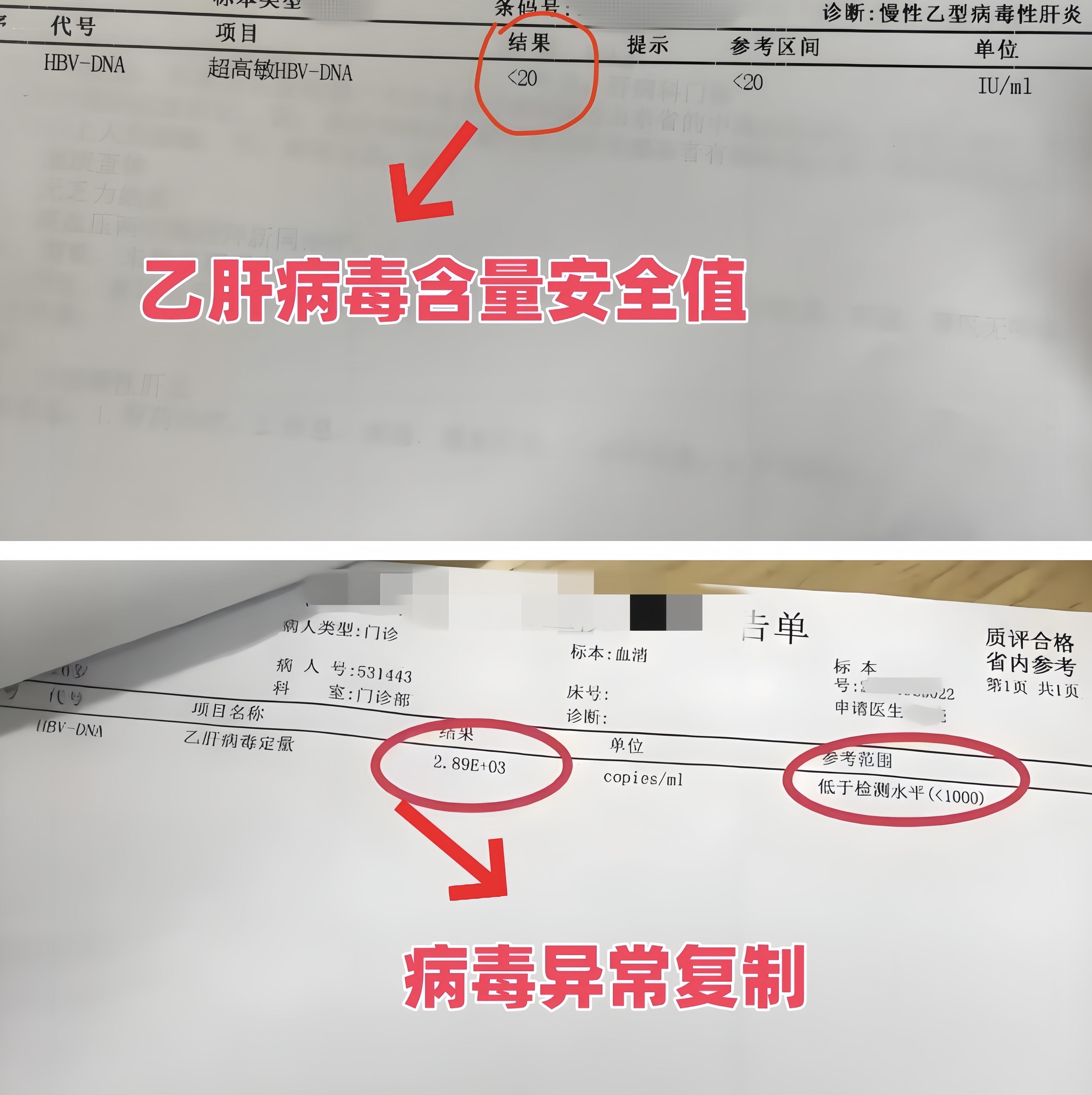 乙肝病毒低于这个标准，恭喜你！病毒不再复制  1、病毒低于20或者10...