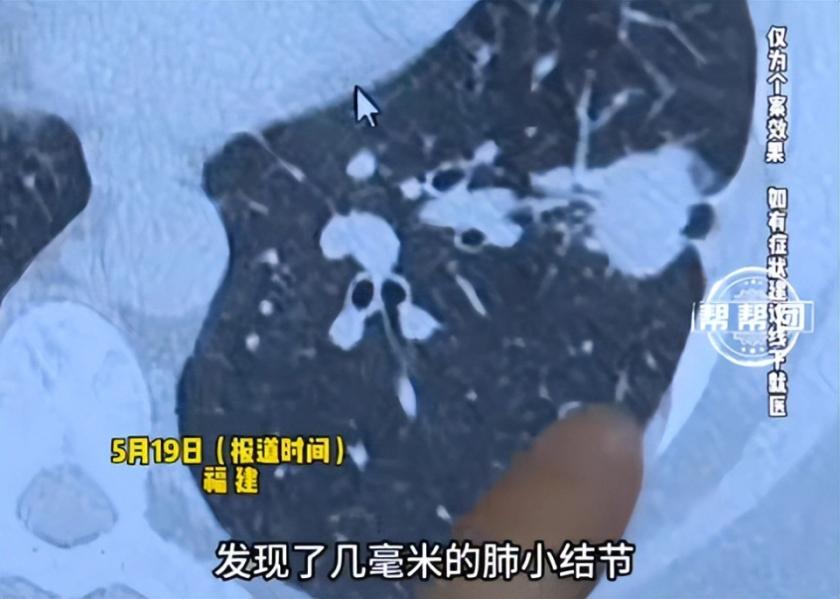 体检查出几毫米的肺小结节，觉得“不痛不痒”就没当回事？福建一位60岁的鲁先生，就
