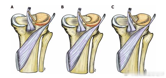 盘状半月板这是一种半月板的先天发育问题，之前也给大家讲过，因为盘状半月板形状