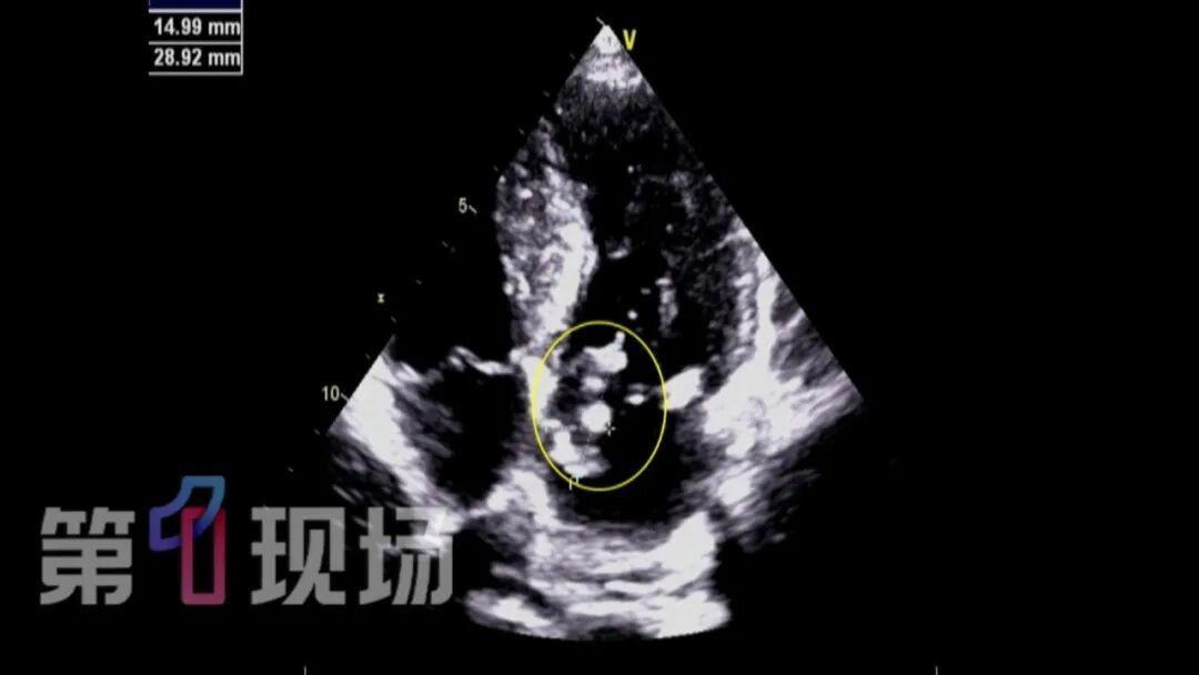 “太吓人了！广东深圳，一51岁男子数月前突然低烧不退、浑身没劲、暴瘦一大圈，跑