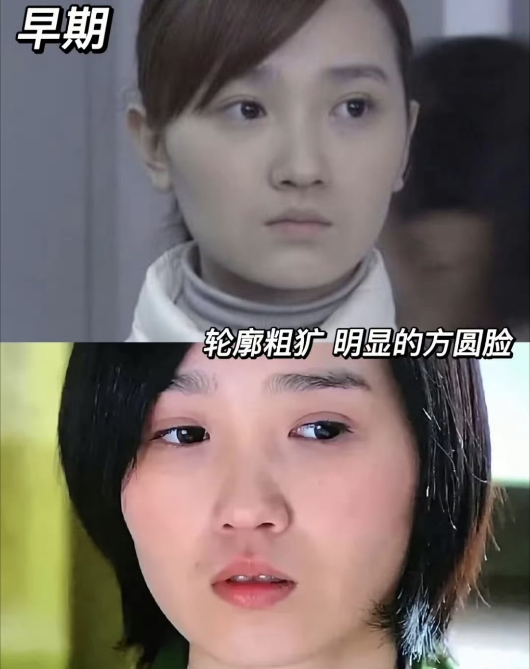 陈小纭出席活动，脸有点肿，和以往“迪士尼在逃公主”的形象反差很大，可能还在医美恢复期。她的原生脸属于