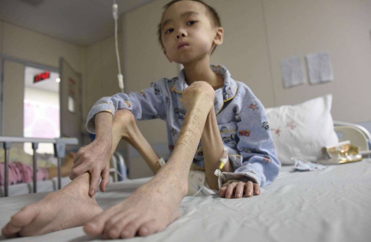 “别拿饮料当水喝！”尿毒症患者的泣血忠告一杯冰可乐、一瓶甜奶茶，似乎是现代人