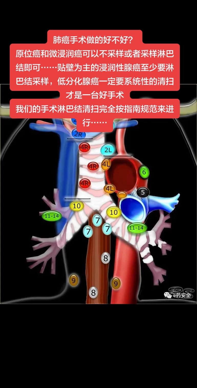 肺癌质控 肺癌手术做的好不好？ 原位癌和微浸润癌可以不采样或者采样淋巴...