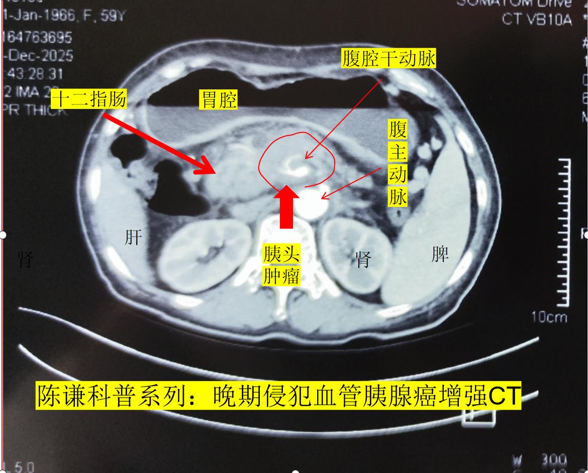 陈谦海扶刀治疗侵犯血管晚期胰腺癌病例11433号这是我们今天海扶刀治疗的一名