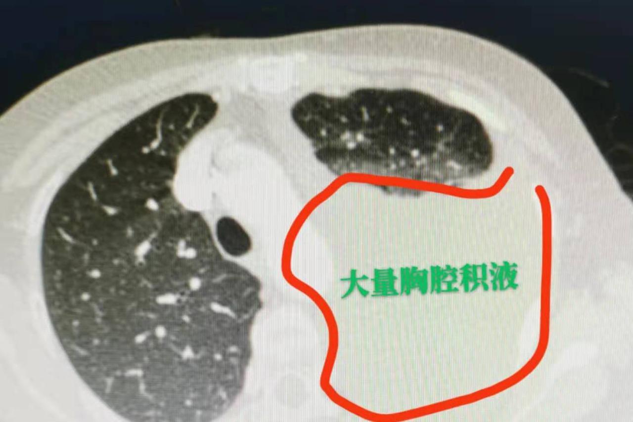 看到报告上“胸腔积液”四个字，很多人的第一反应就是慌了：是不是肺癌？先别焦虑，胸