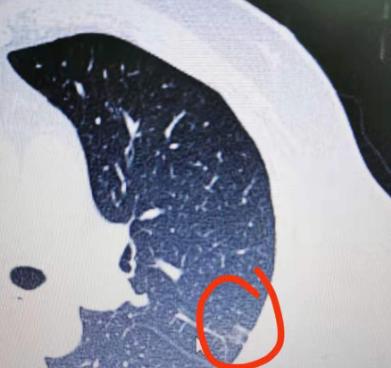 如果你不做手术，这几年可以活得很好！今年50岁的杨先生，两年多前体检时查出了肺磨