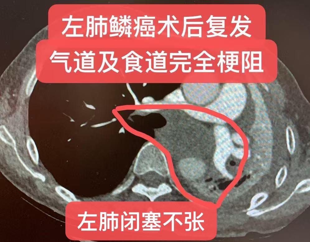 早期左肺鳞癌术后 复发的挽救治疗。左肺鳞癌术后IA3期，中分化，未做任...