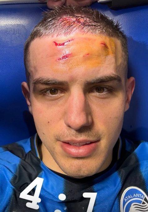 【一点办法没有】意甲——科尔维鲁莽出击没碰到球，撞击奇克，奇克重伤，不仅没有VA