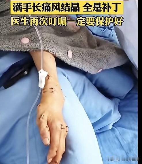 28岁小伙满手痛风结晶！这些“快乐水”真的别再猛灌了真的太痛心！才28岁的小