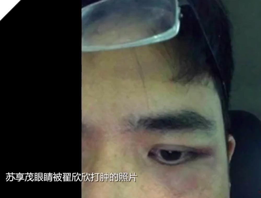 苏享茂在结婚前，就曾被翟欣欣打得鼻青脸肿！[打脸]只可惜，那时候他爱得太深沉、太
