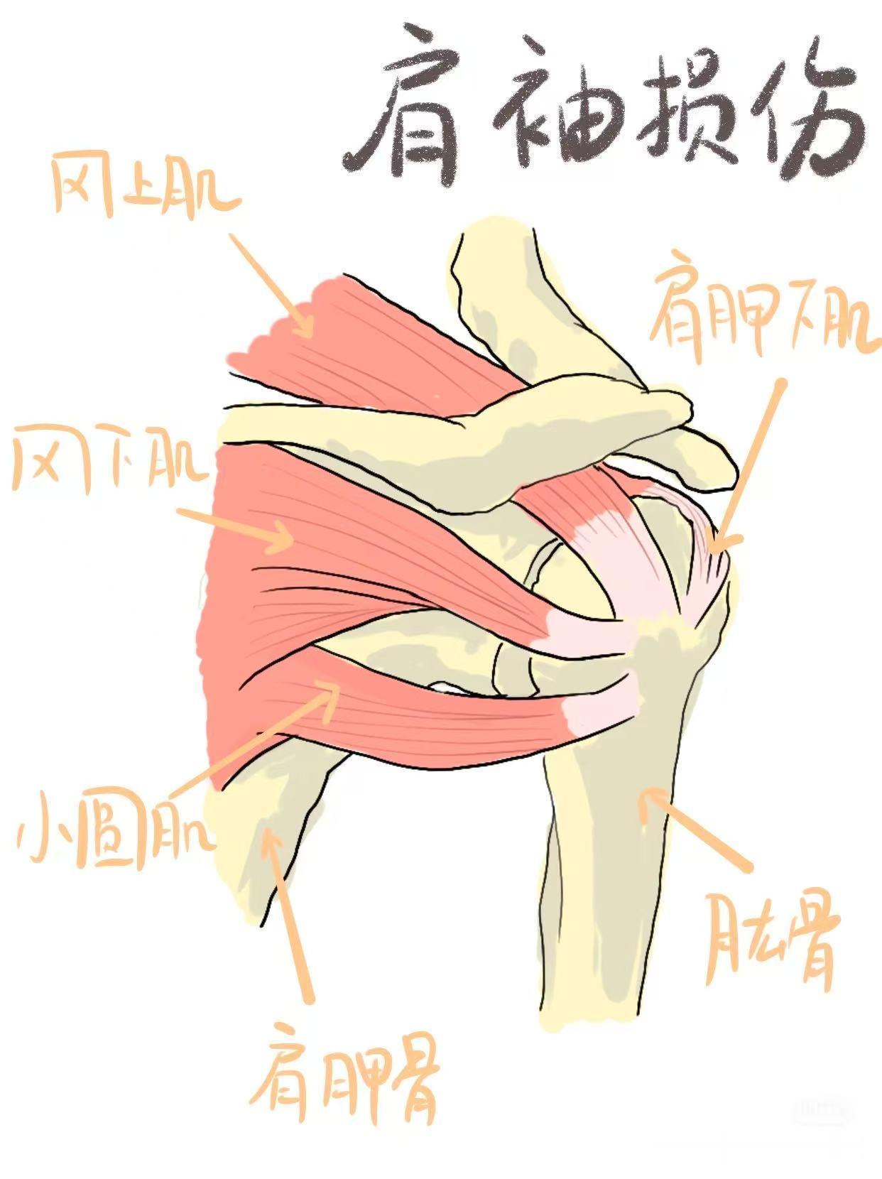 肩袖损伤【认识你的肩袖】之前总是说肩袖损伤、肩膀疼痛，那肩袖到底是啥？肩袖肌群