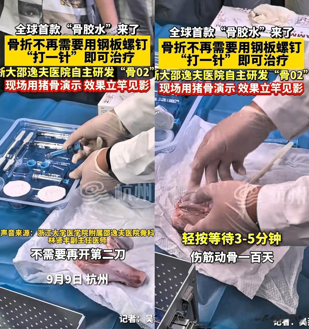 这下可炸锅了！全球首款“骨胶水”横空出世，浙江邵逸夫医院这次直接把骨科难题给“粘