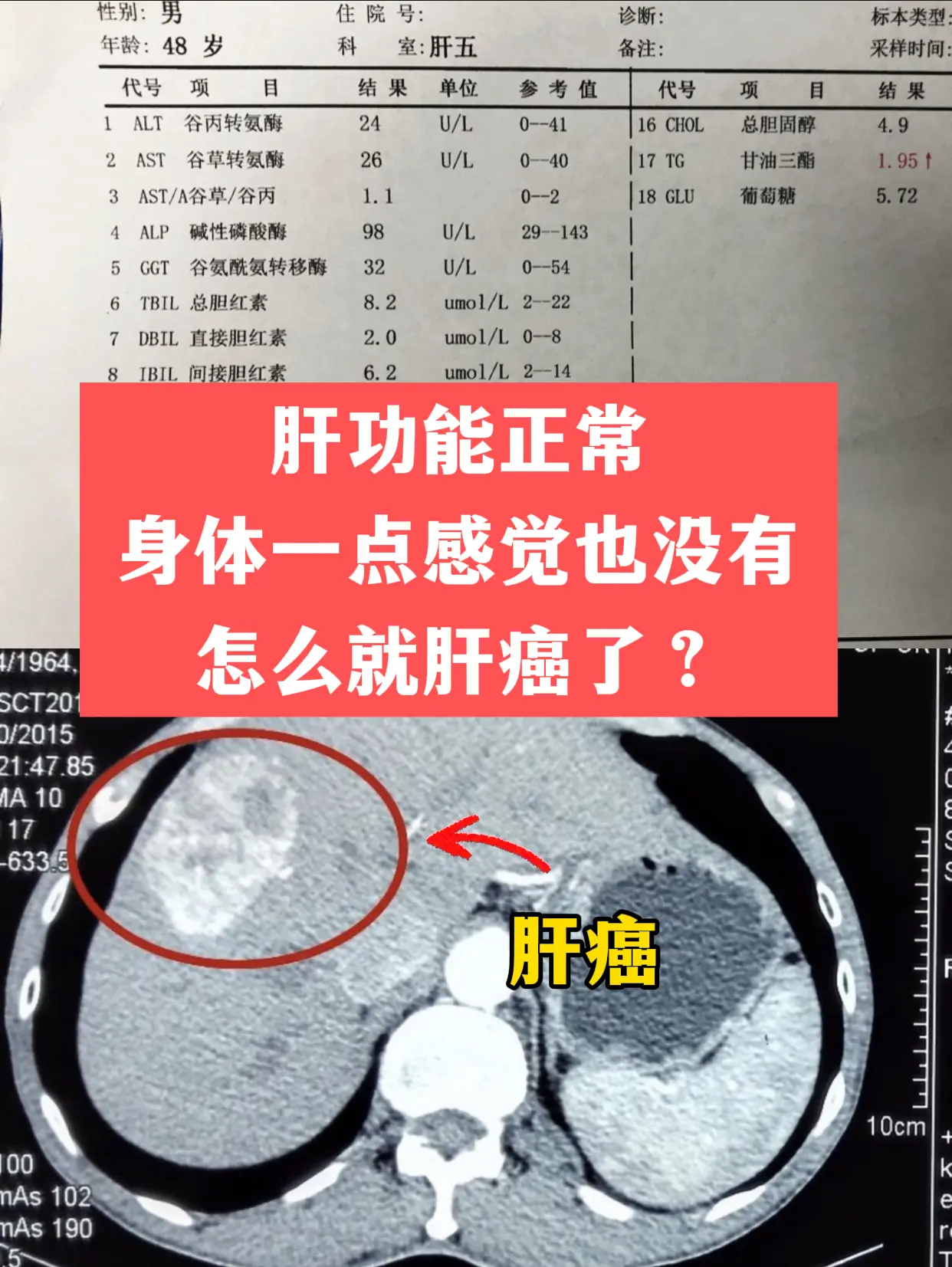 门诊上遇到一位河南的患者，有乙肝好多年，平时能吃能睡，一点感觉都没有...