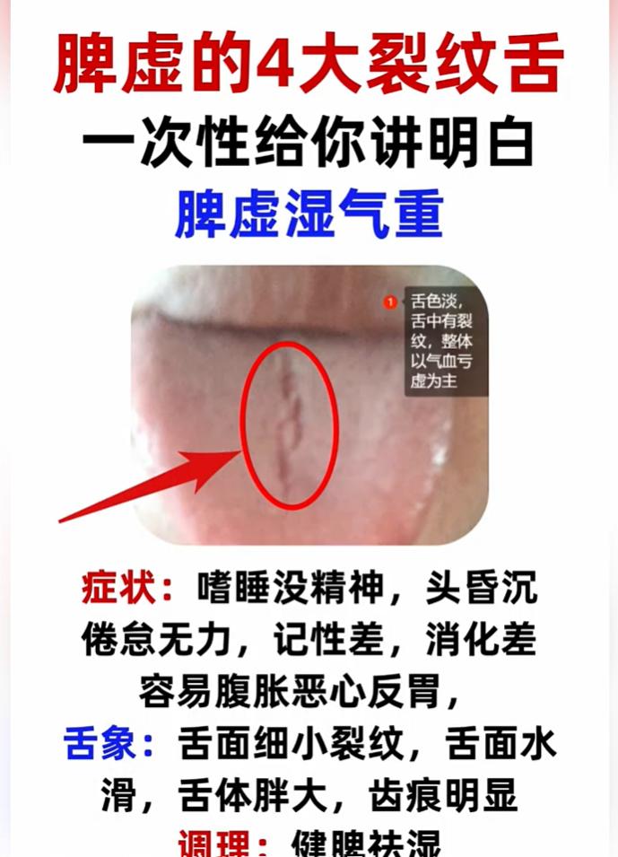 舌有裂纹不等于全是阴虚，4种脾虚裂纹舌，教你简单辨别