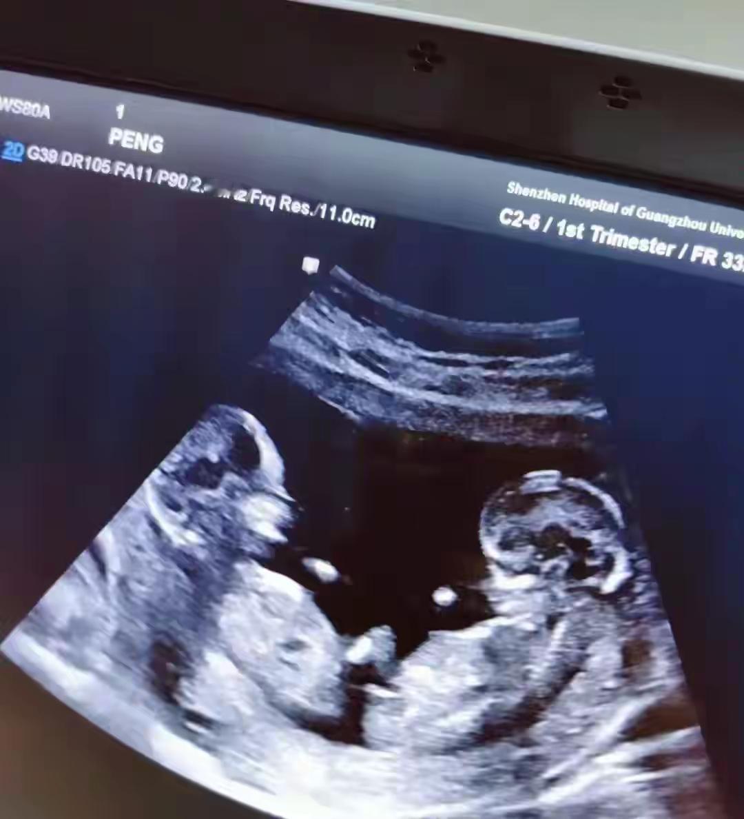 三次产检都没查出双胞胎，真的只是孩子贴太紧？有人说这就是个意外，俩娃贴太近