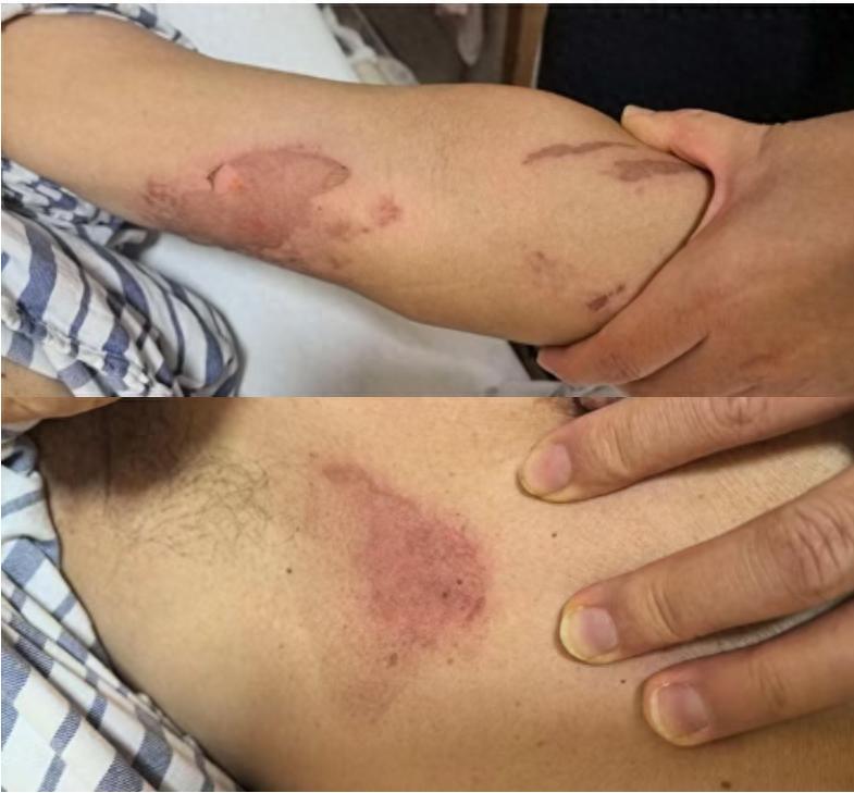 浙江，一60多岁男子因饮食不当腹泻发烧，女儿心急之下翻出家里存货，心想干冰比冰还