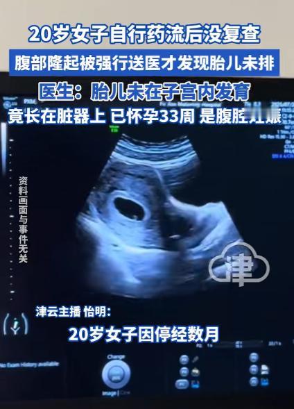 哈尔滨一名20岁的姑娘，因为停经好几个月，自己怀疑是怀孕了，既没敢告诉家人也没去