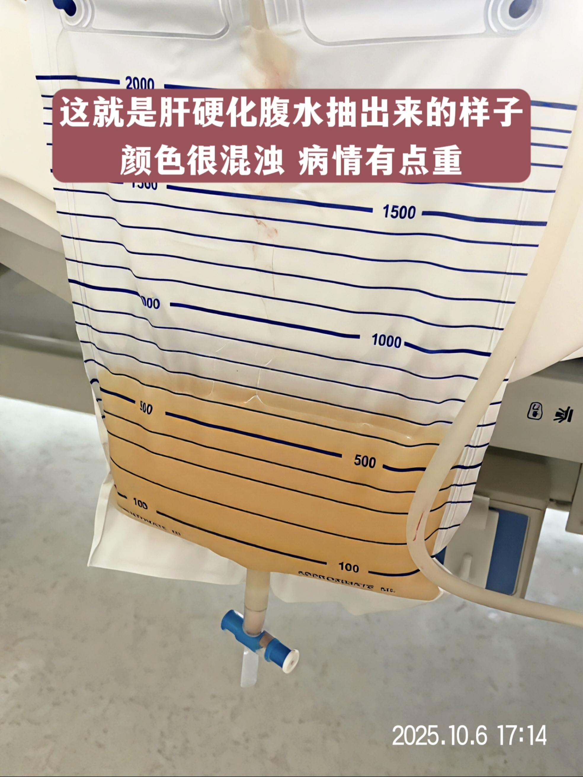 这是一位52岁肝硬化晚期患者1天抽出来的腹水，减轻了患者腹部压力，患者...