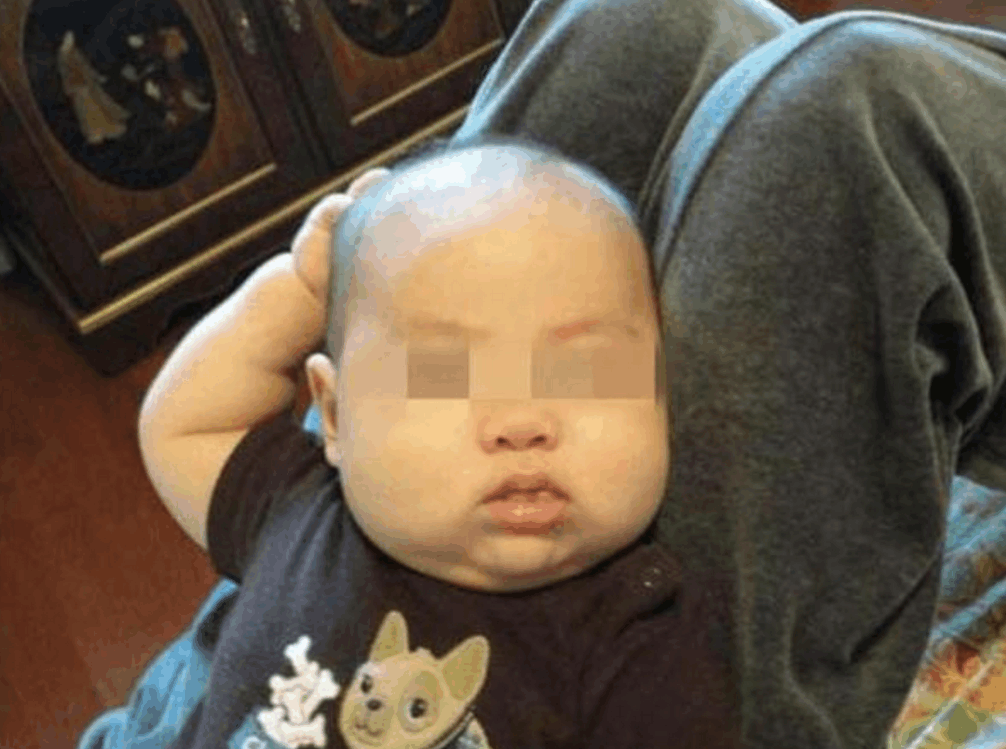 快满1岁的孩子老摸头, 医生说怎么不早点送来, 父母很自责