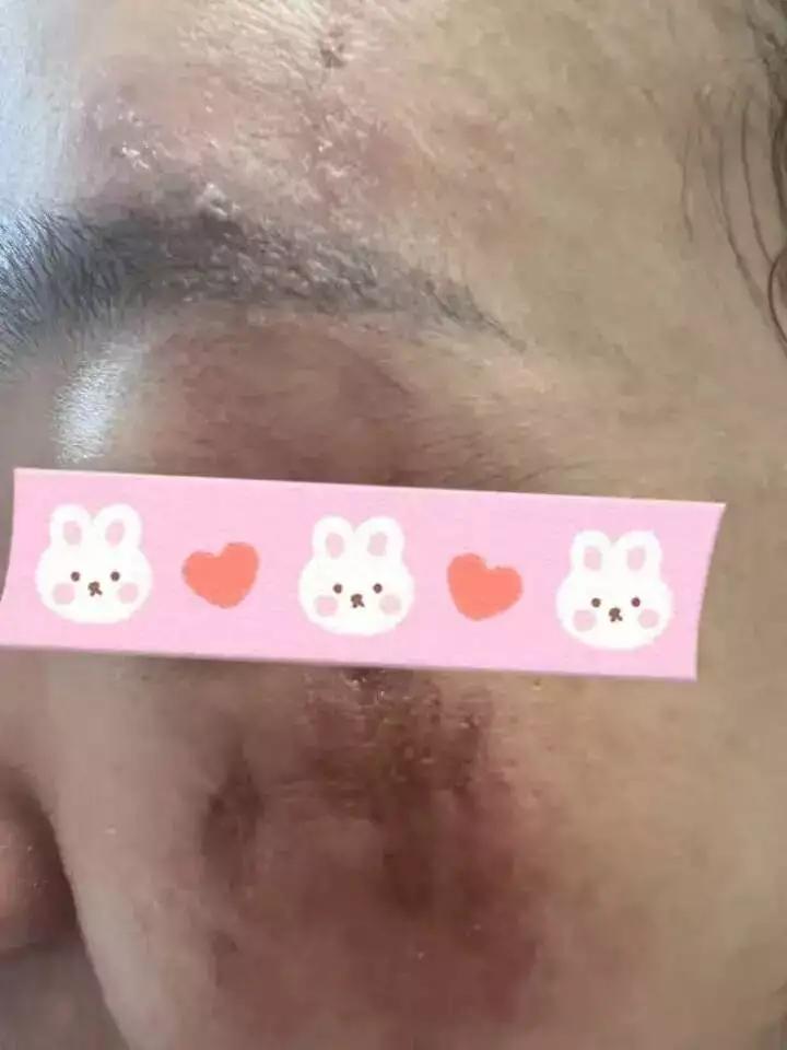 浙江杭州，一50岁男子凌晨被胸口灼痛惊醒，发现胸腹部出现暗红色怪异红斑并布满水疱
