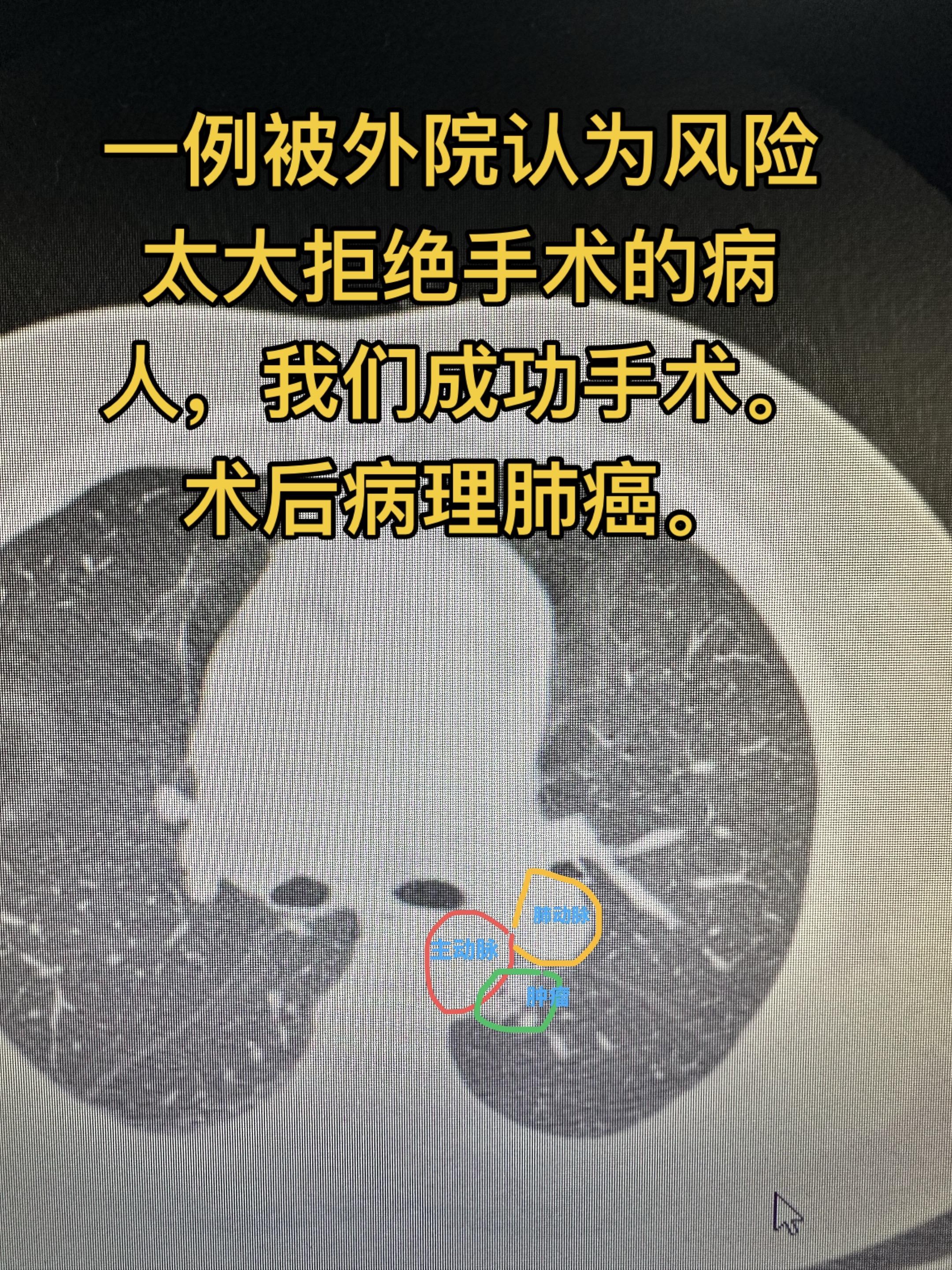 身边有靠谱医生朋友的重要性！这个病人在某特大型医院就诊，胸外科说肿瘤的...